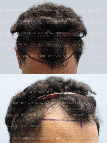 Before Hair Transplant