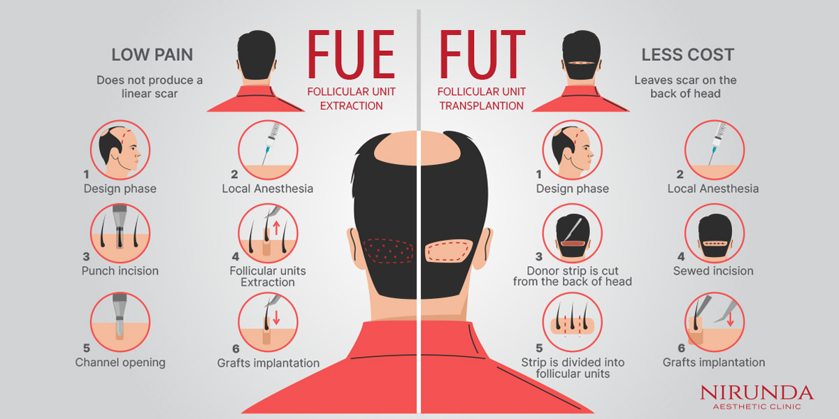 Hair Transplant Procedure