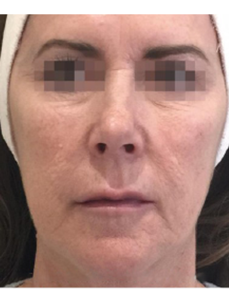 After Profhilo Set 1