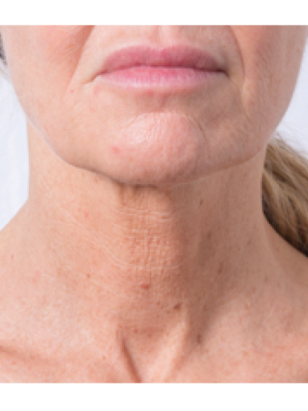 After Profhilo Set 2