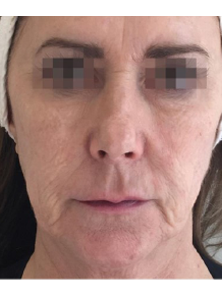 Before Profhilo Set 1