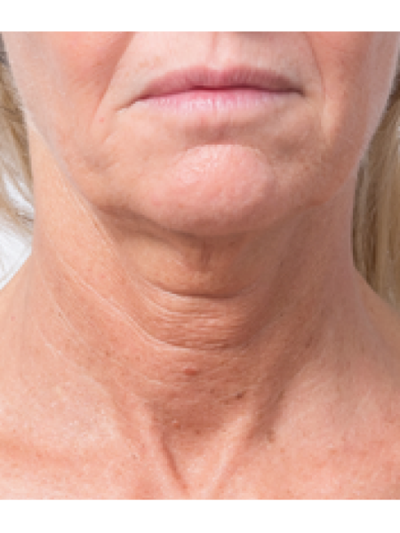 Before Profhilo Set 2