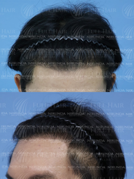 Hair Transplant After Treatment Case 3