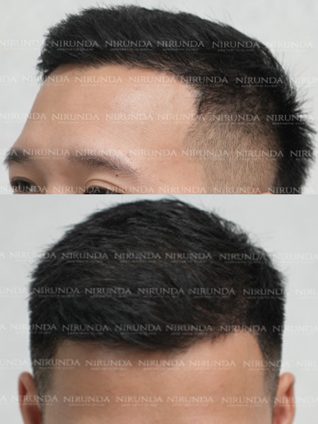 Hair Transplant After Treatment Case 4