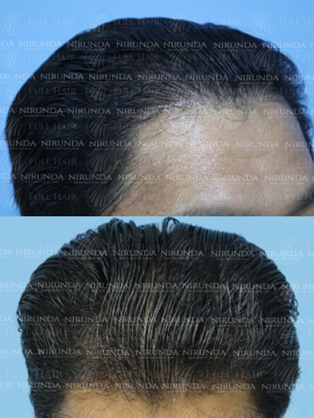 Hair Transplant After Treatment Case 1