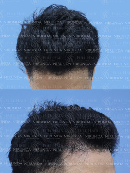 Hair Transplant After Treatment Case 2