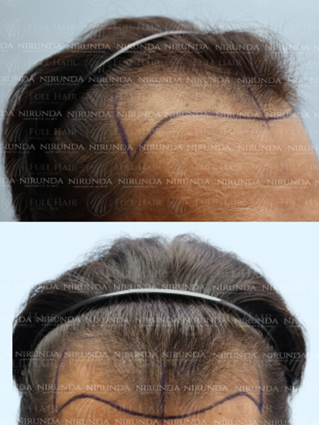 Hair Transplant Before Treatment Case 1