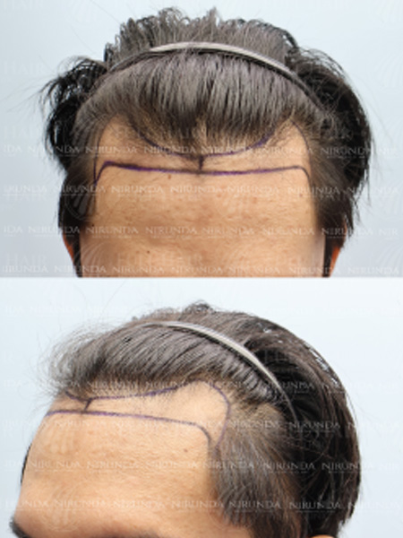 Hair Transplant Before Treatment Case 3