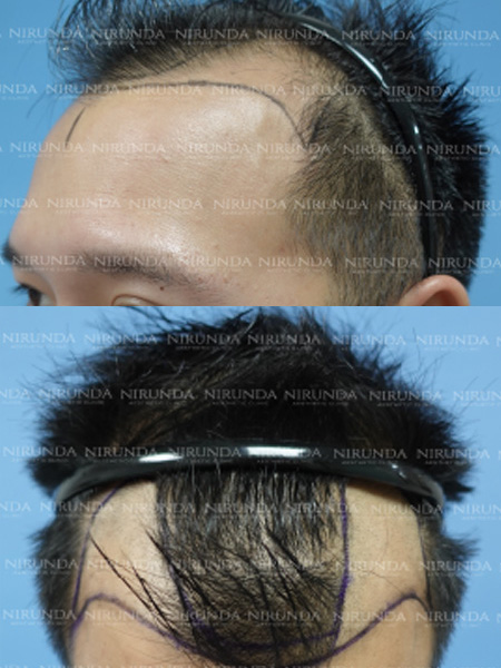 Hair Transplant Before Treatment Case 4