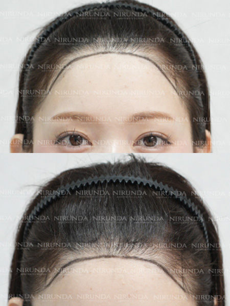 Hair Transplant Before Treatment Case 5