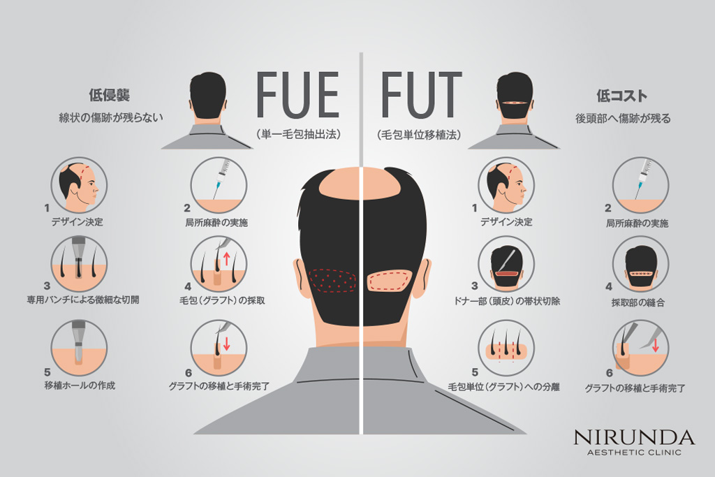 FUE vs FUT Technique Comparison Nirunda Clinic Bangkok