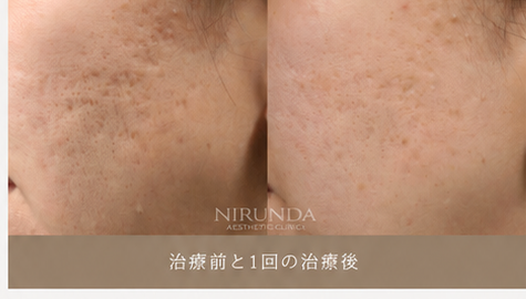 POTENZA Clinical Case Before & After