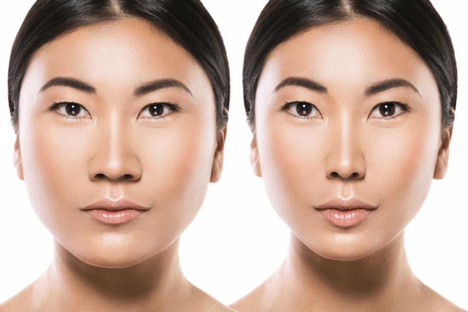 rhinoplasty surgery can have a dramatic impact.