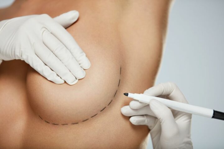 Breast augmentation is a popular cosmetic surgery for both locals and foreigners.