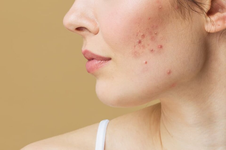 Adult acne can appear suddenly.