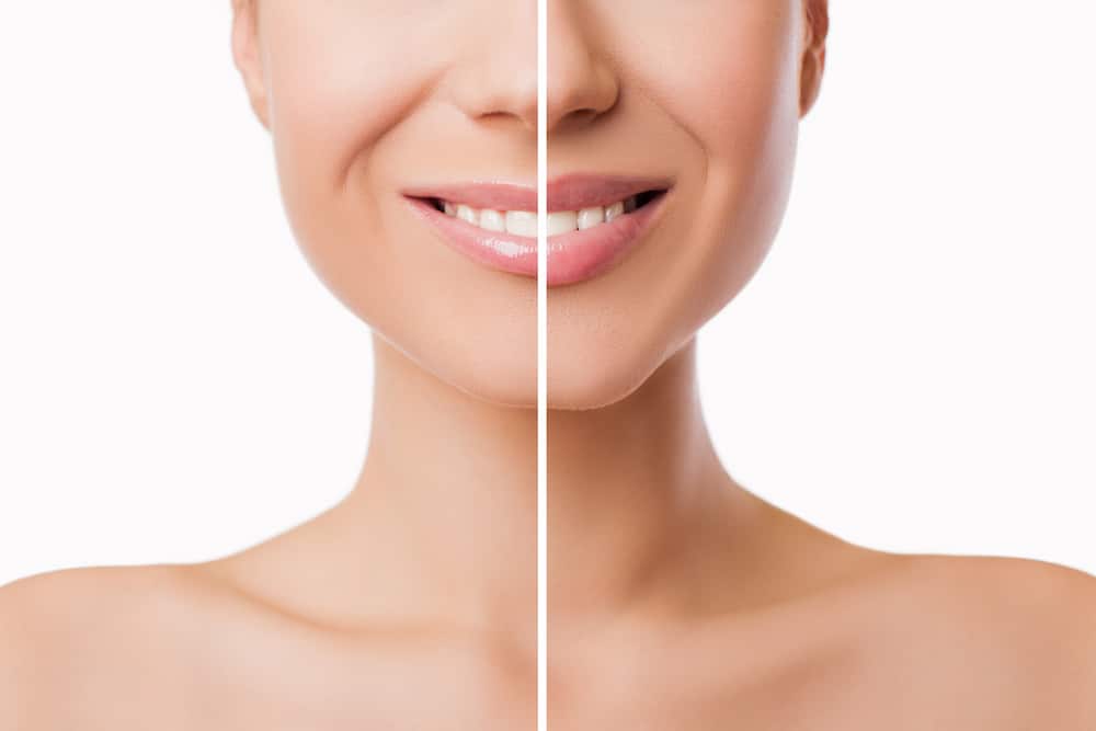 Enhance your smile with lip fillers
