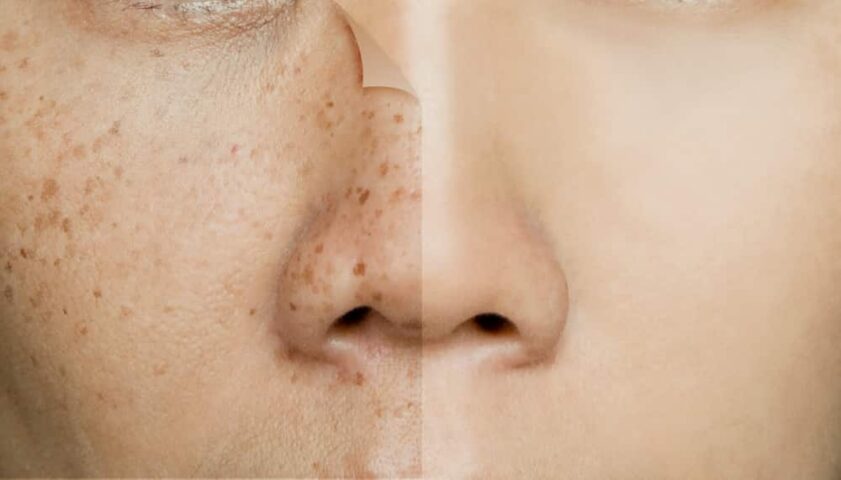 Freckles are easily treatable.