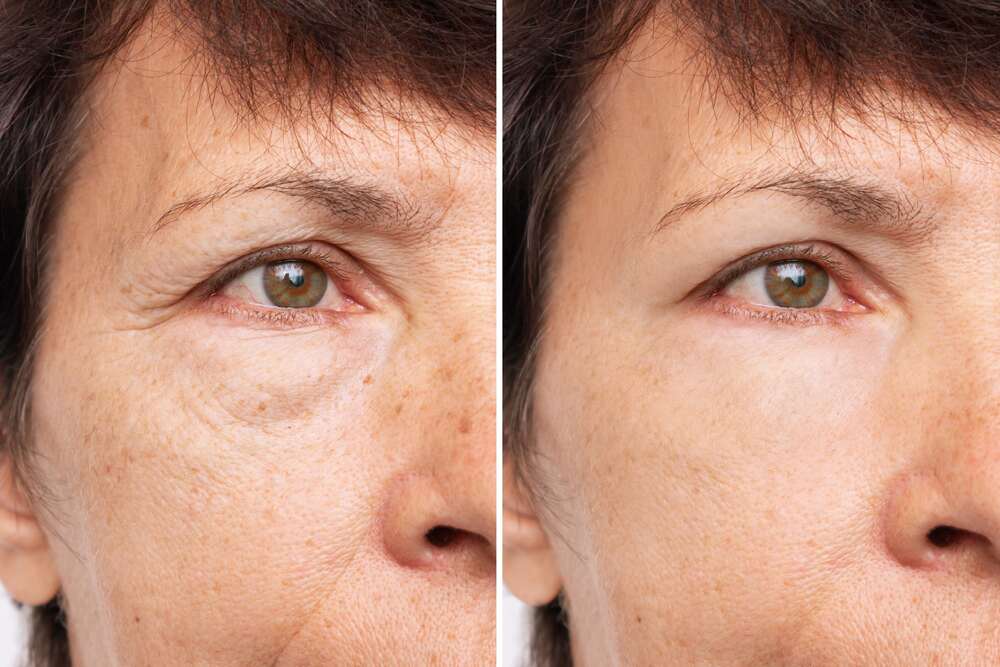 Refreshed and rejuvenated: Before and after fillers