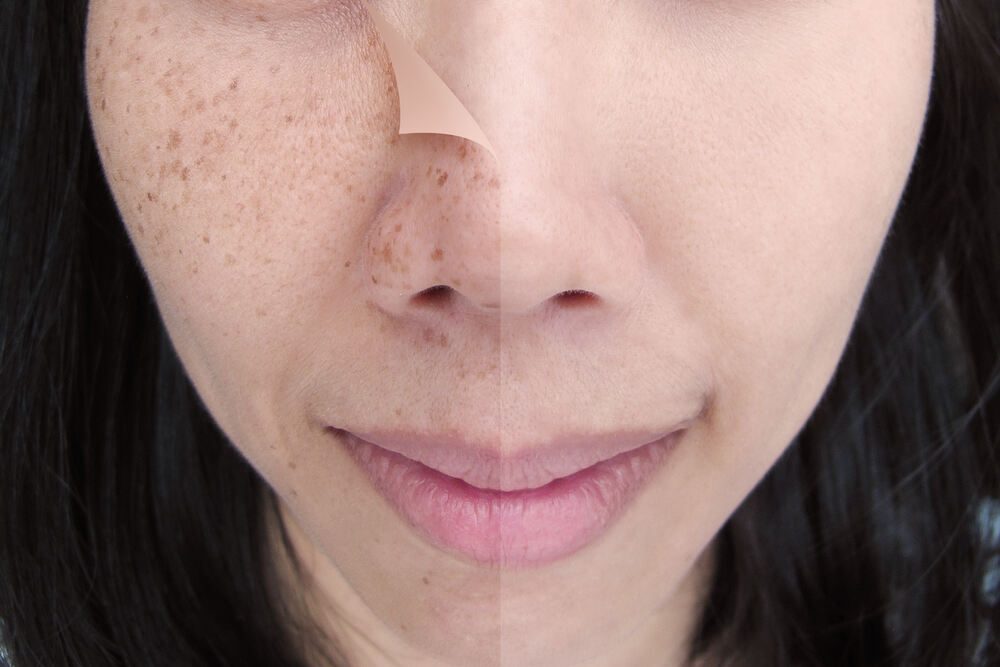 There are effective treatments for melasma and freckles.