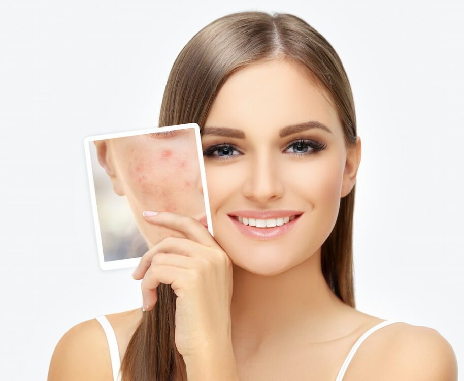 A smiling woman with blemish-free skin holding up a photo of her face with acne
