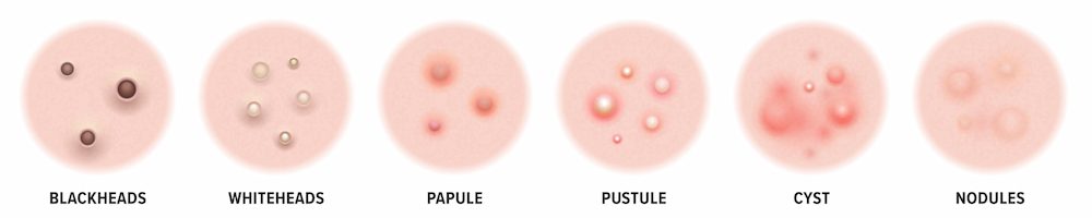 An illustrated image showing the different types of acne