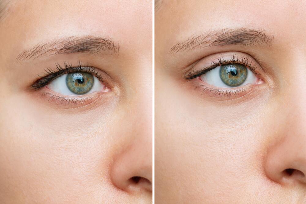 Before and after upper eyelid surgery