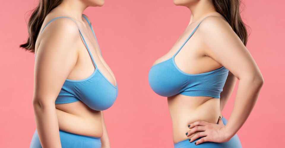Breast lift: Your surgical fix for sagging breasts