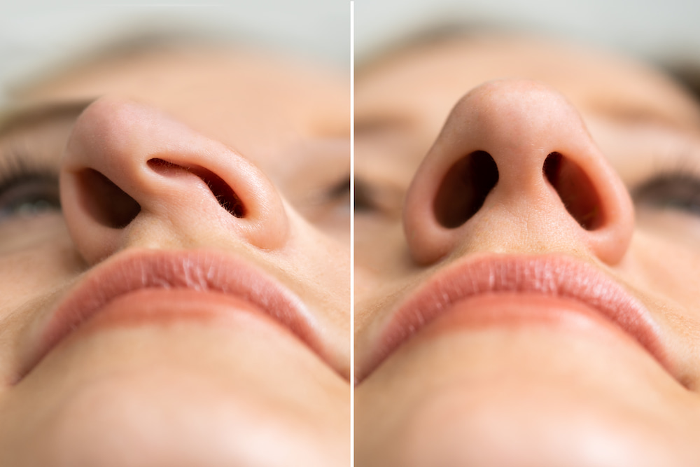 Before and after a rhinoplasty to improve breathing