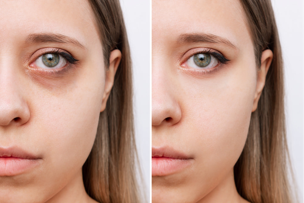 Before and after treatment shots of a young woman with dark eye circles