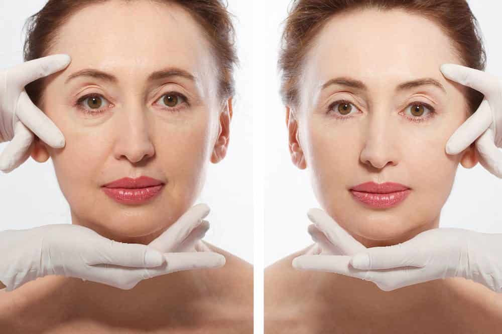 Before and after facelift photo of a woman’s full face.