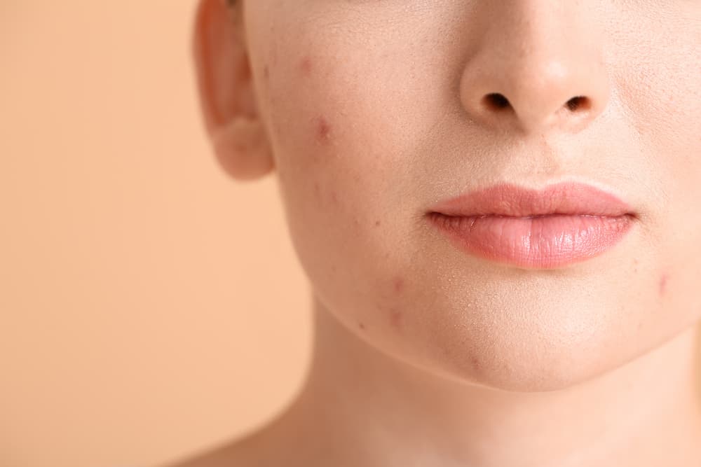 Before and after laser acne treatment