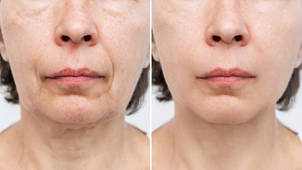A before and after rhytidectomy photo of a female patient’s lower face.