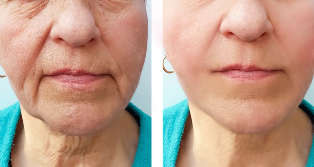 Before and after Sculptra treatments