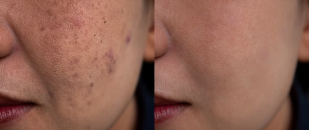 Before and after shots of a woman’s skin pigmentation treatment.