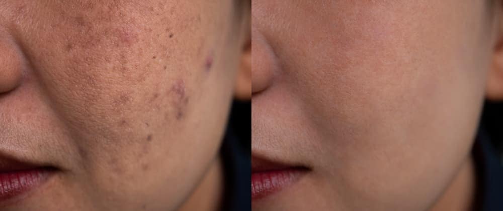 Before and after shots of a woman’s skin pigmentation treatment.