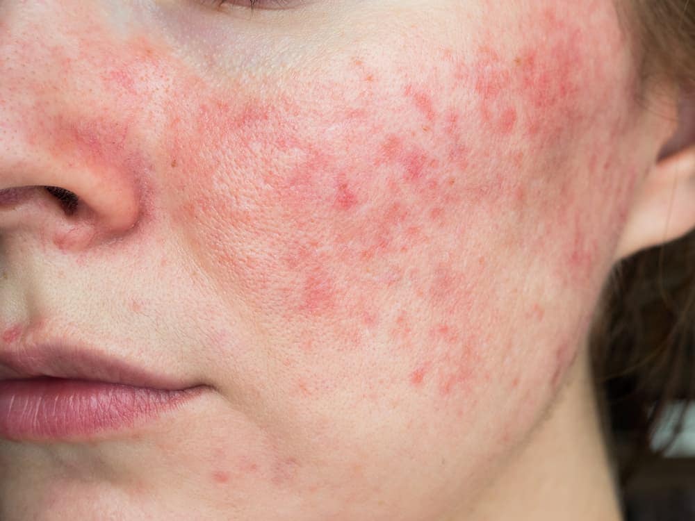 Identifying Rosacea early can help treat it better