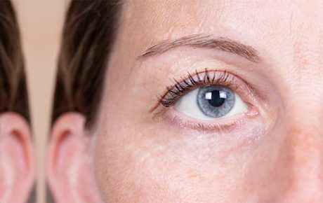 A blepharoplasty can rid your eyelids of loose, baggy skin.