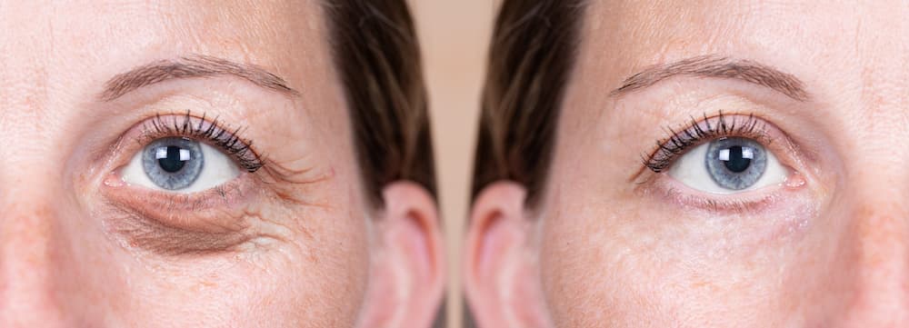 A blepharoplasty can rid your eyelids of loose, baggy skin.