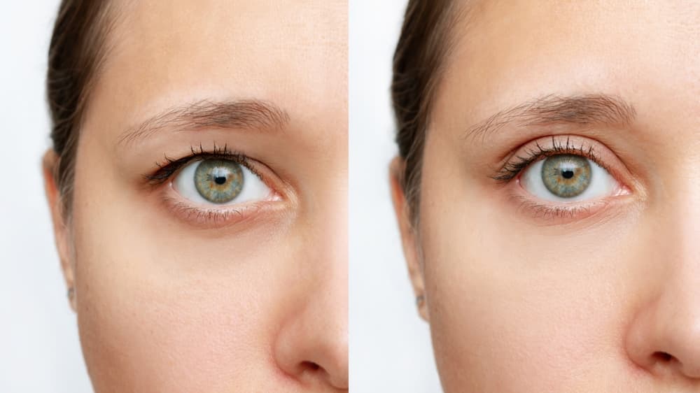 Upper blepharoplasties can make you look younger.