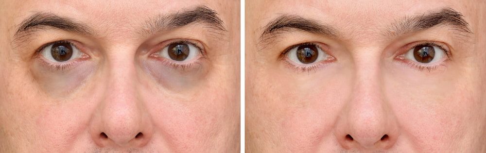Lower eyelid blepharoplasties can get rid of dark circles.