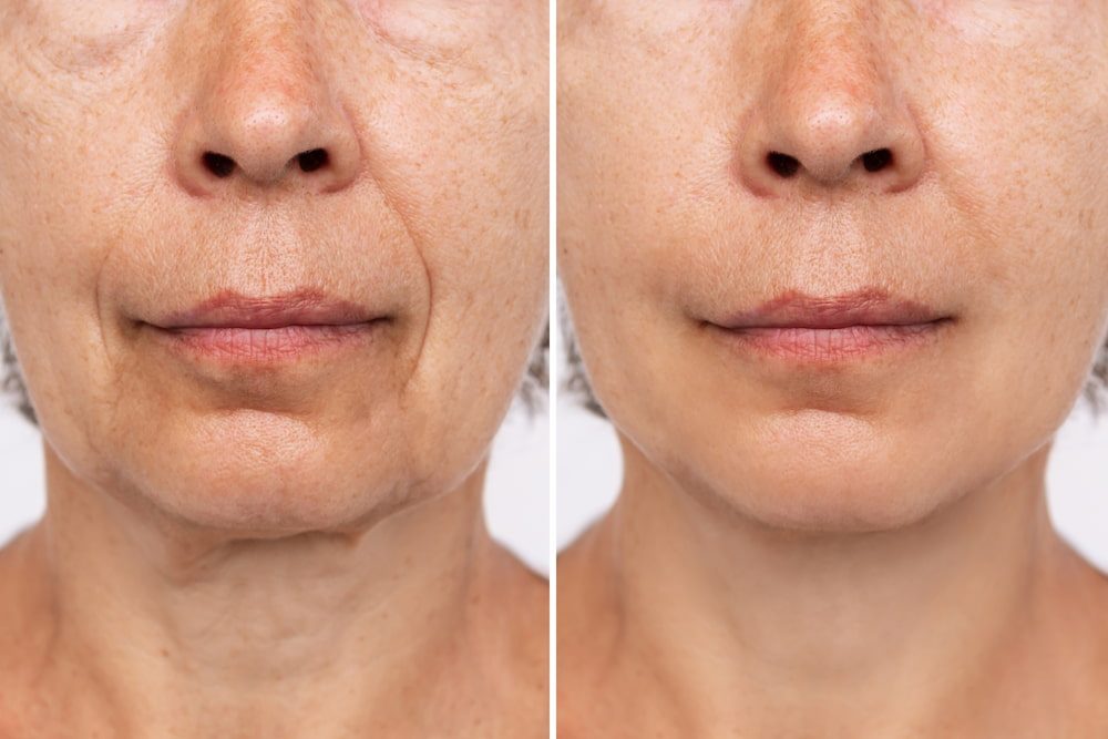 Before and after facial filler treatment