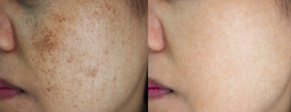 Before and after skin discoloration treatments
