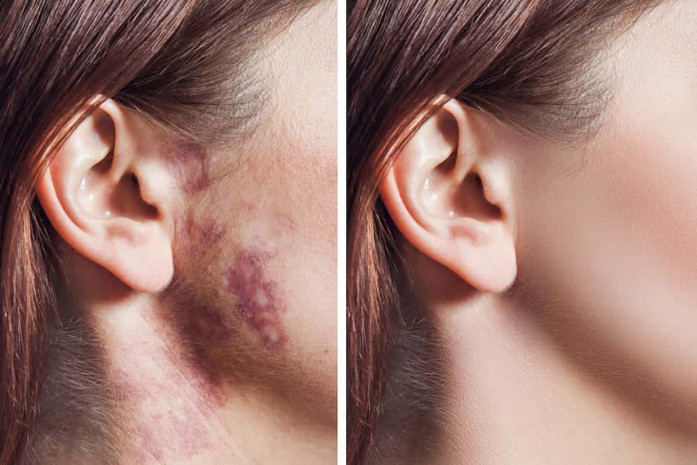 Many types of birthmarks respond to laser therapy