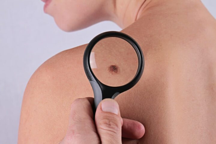 Nearly 80% of the population has a birthmark.
