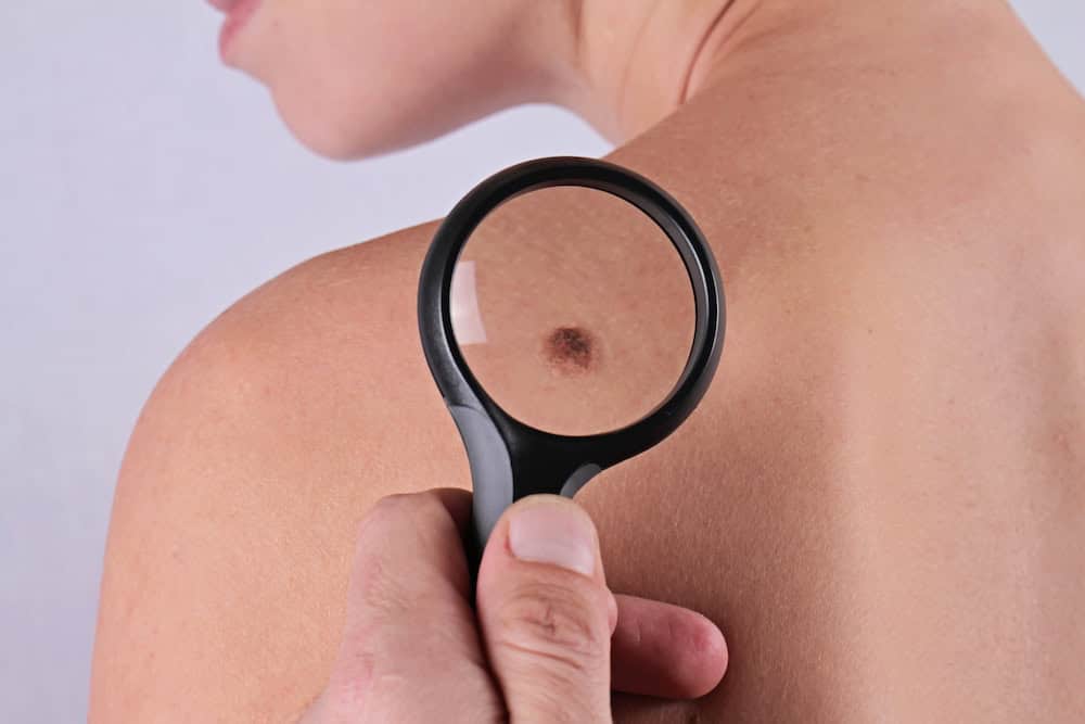 Nearly 80% of the population has a birthmark