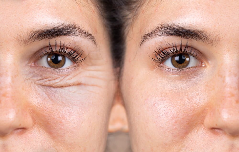 Before and after photo of a woman who had an eyebag removal procedure