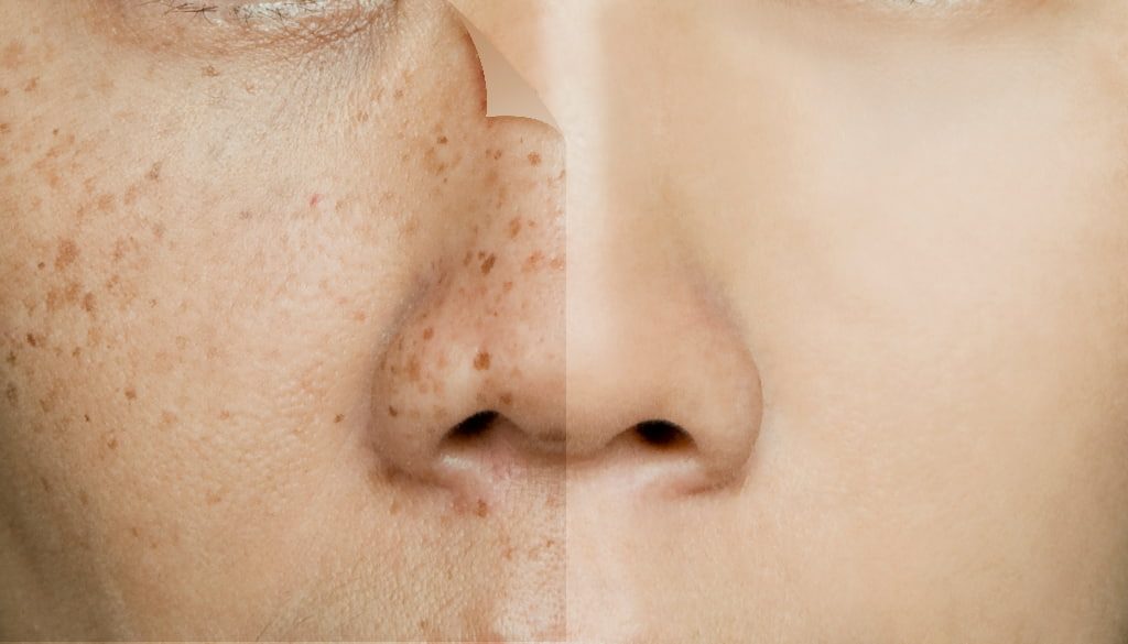 freckles removal clinic in Bangkok