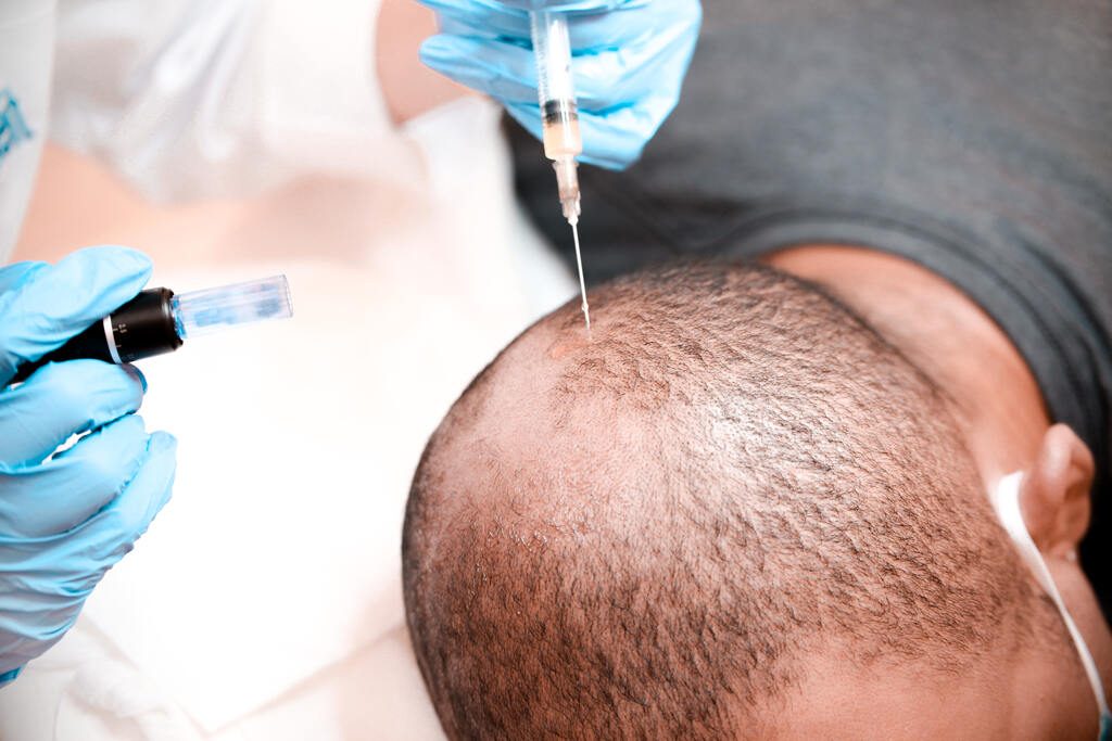 PRF therapy is a popular hair restoration treatment