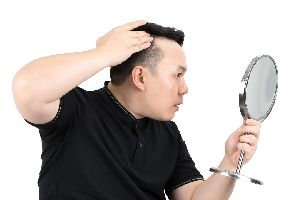A hair transplant is a permanent solution to thinning hair