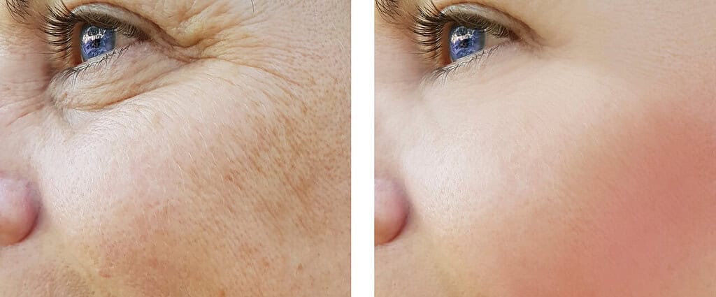 A woman’s face before and after Rejuran injection